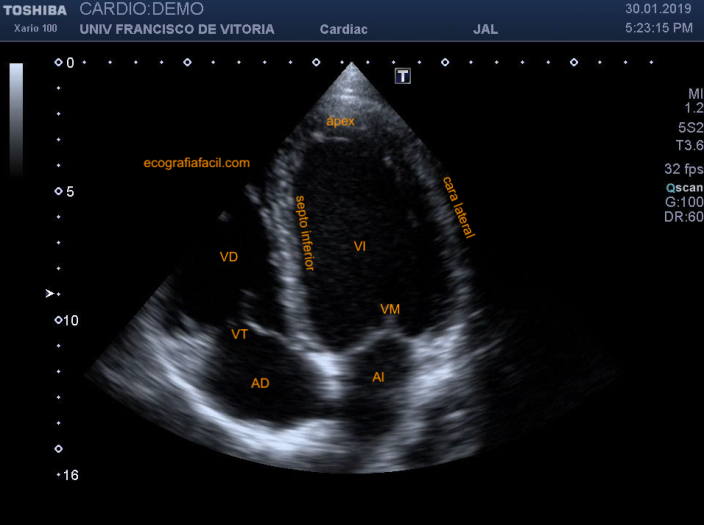 142. Ecocardiografía.Plano Apical 4 cámaras – Ecografía Fácil