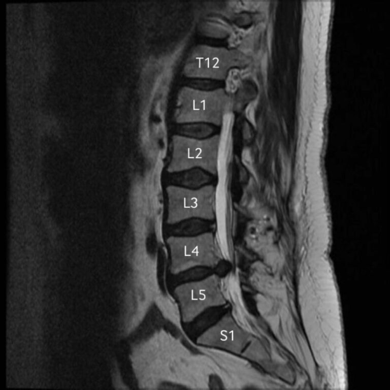 Lumbar Spine MRI Scan (Lower Back) - Priority Diagnostics