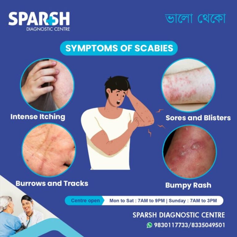 Scabies: Symptoms, Causes, Treatment, and Prevention Explained - Sparsh ...