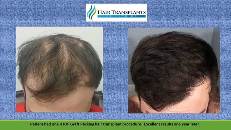 Orlando Hair Restoration Surgeon | Best Hair Transplant Clinic in Orlando